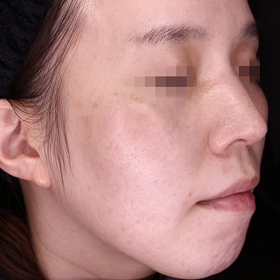 Picosure pro after image